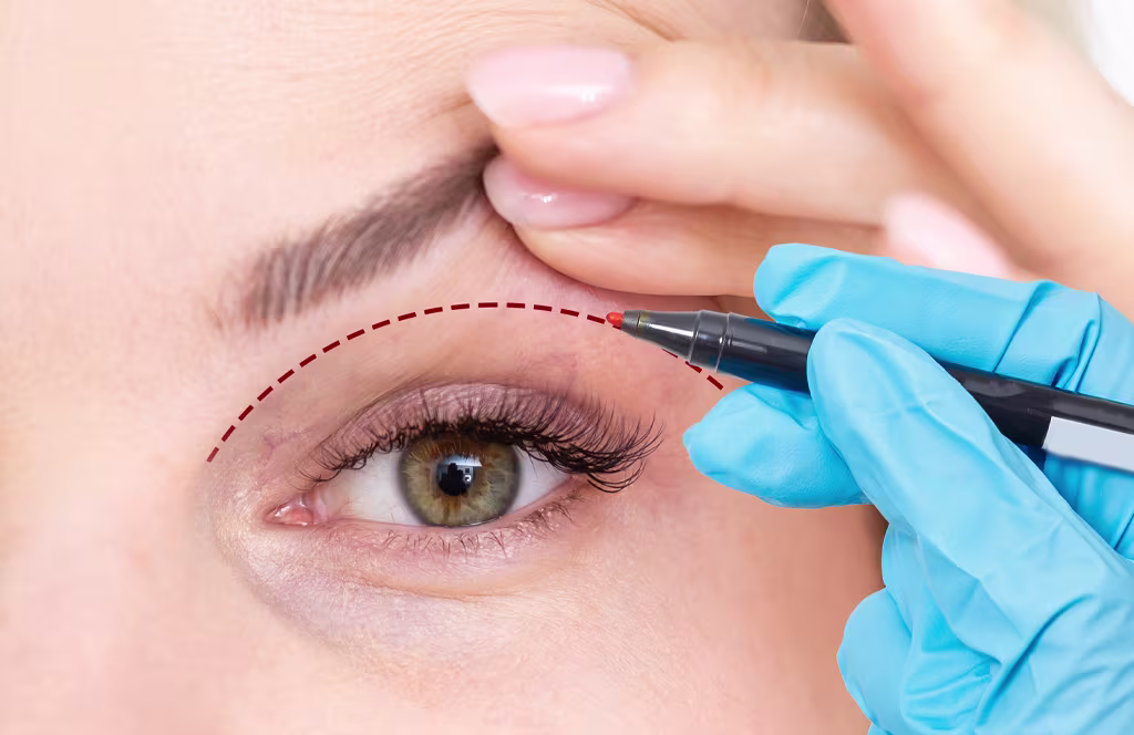 Eyelid surgery - Dr Cole Rojas